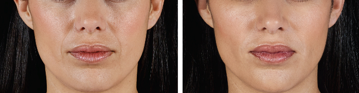 lower half of female patient's face before and after juvederm injections