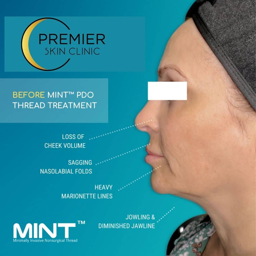 Everything You Need to Know About the PDO Thread Lift Premier Skin Clinic