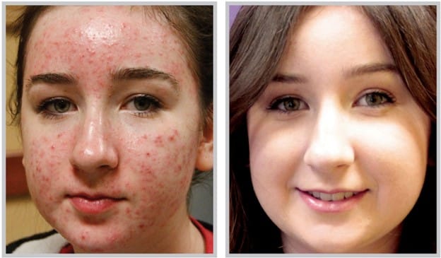 A young girl appears in side by side before and after photos. On the left, she has severe acne on her entire face and jawline. On the right, she is acne free, has reduced redness, and is smiling.]