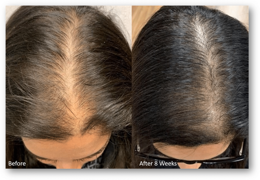 https://premierskinclinic.com/wp-content/uploads/2024/02/Photos-show-a-womans-scalp-before-and-after-KeraLase-treatment.png?utm_source=chatgpt.com