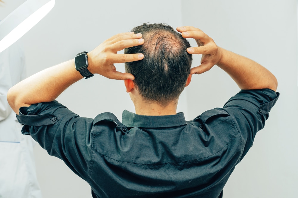 Man touching his balding spots and in need of a KeraLase hair treatment for fuller, healthier hair.