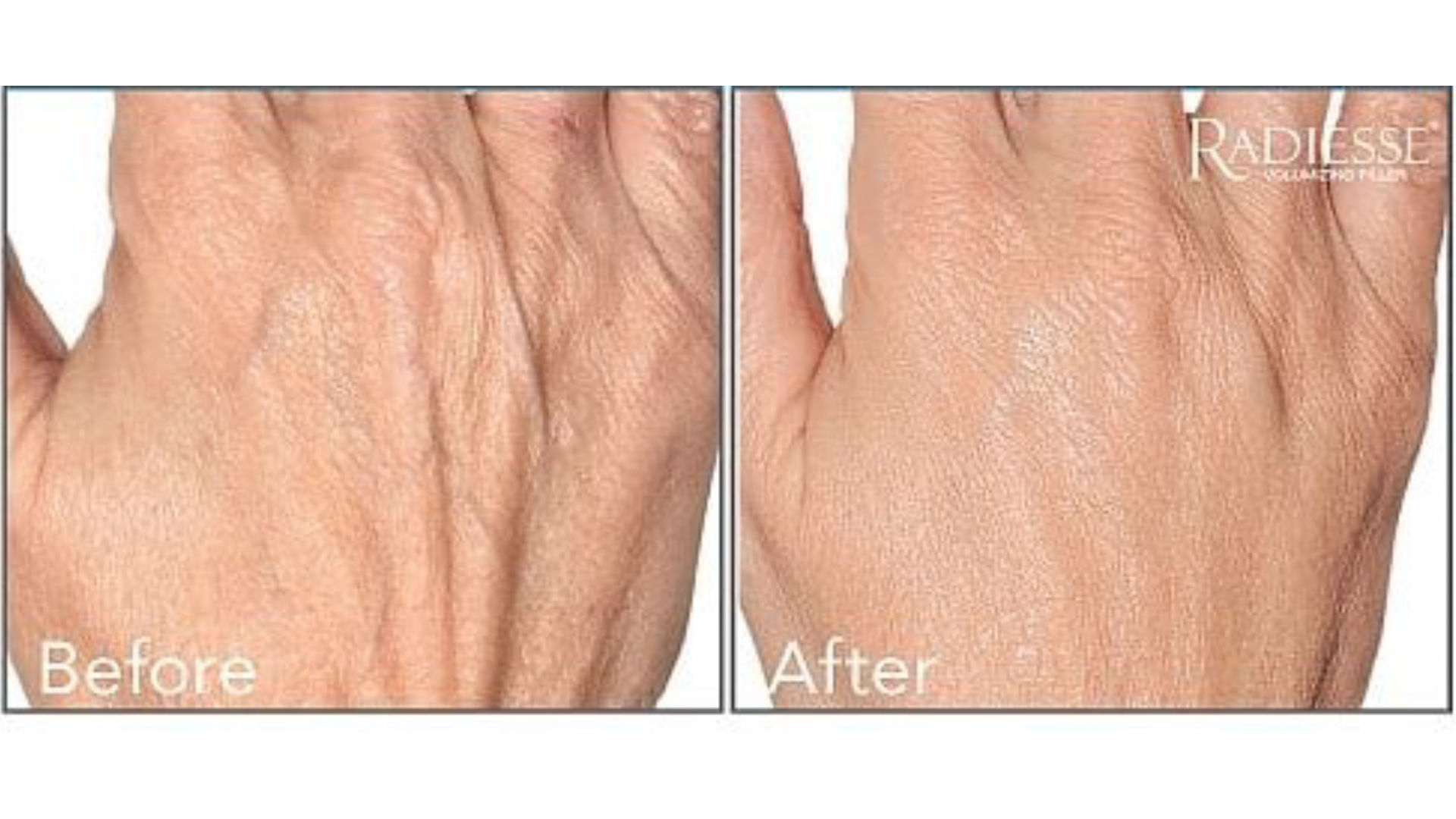 Radiesse-Hands-2