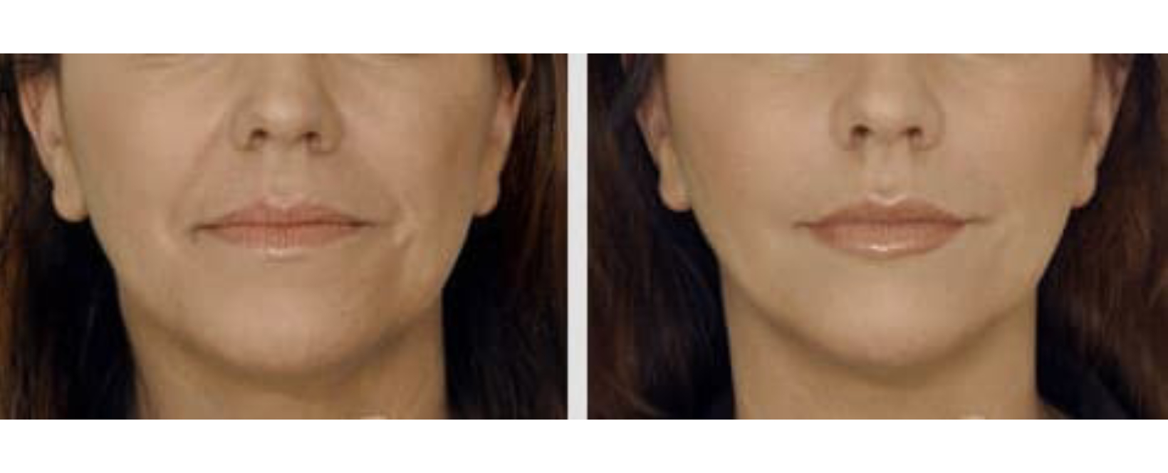 Restylane-Lyft-2