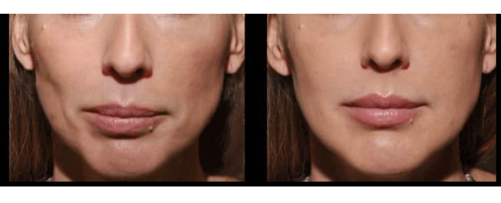 restylane-lyft-before-after-client-one-2