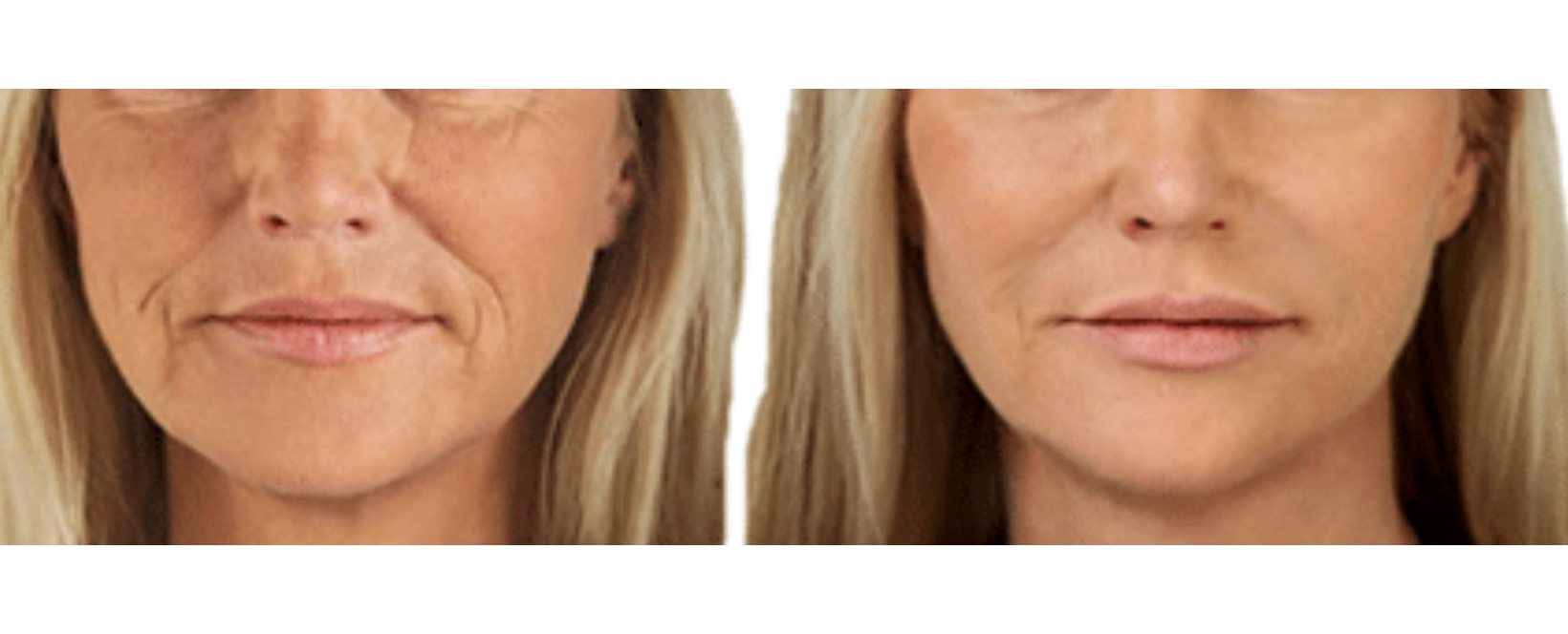 restylane-2