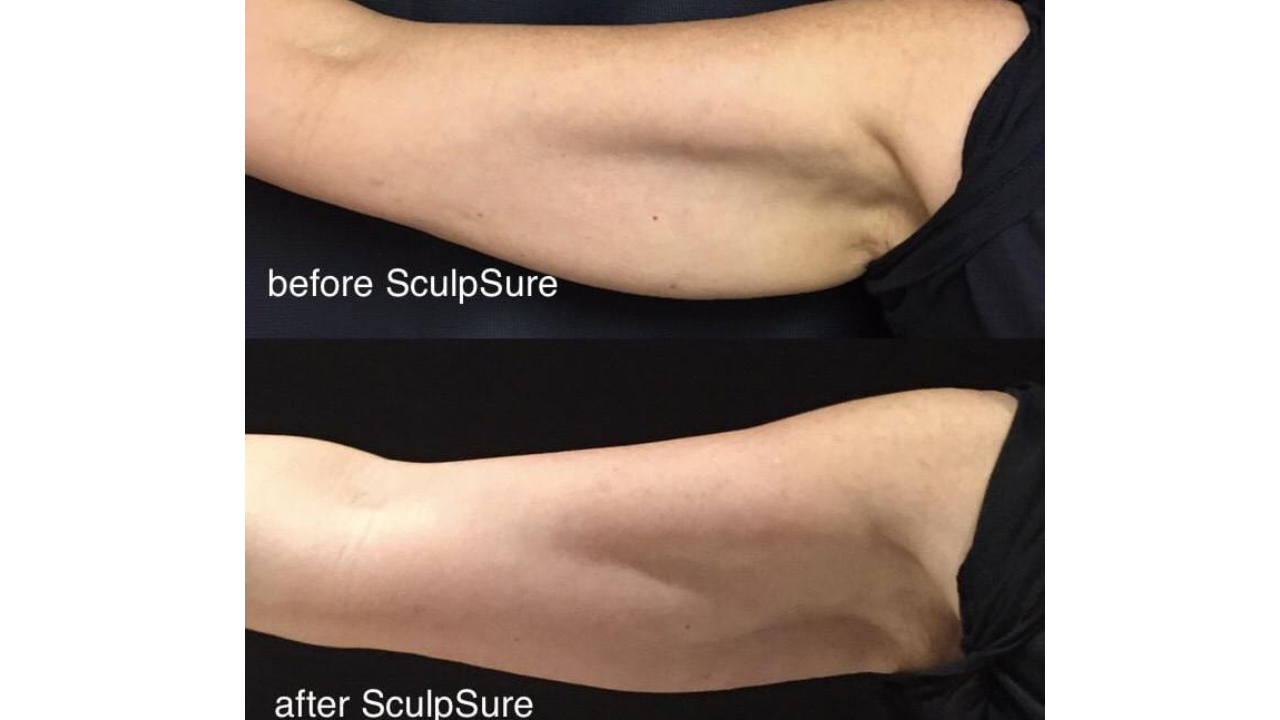 arm-2