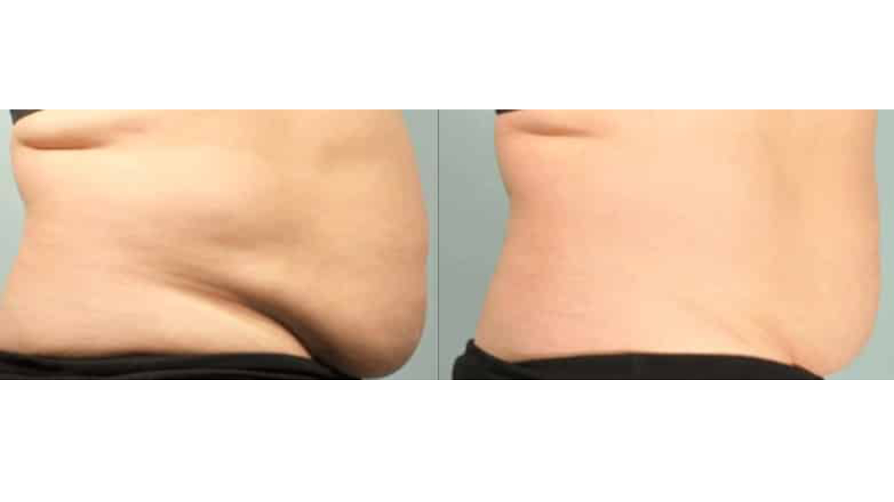 egea-spa-sculpture-before-after-1a-2