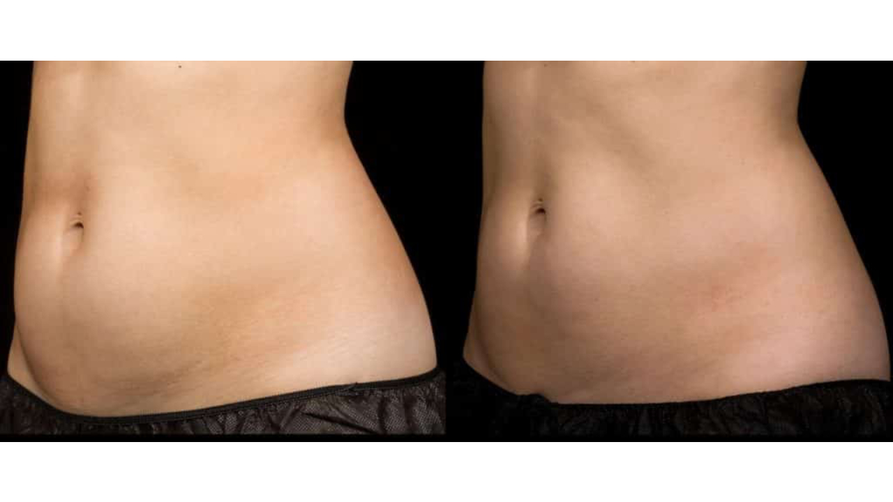 sculpsure-before-and-after-1-2-1024x437