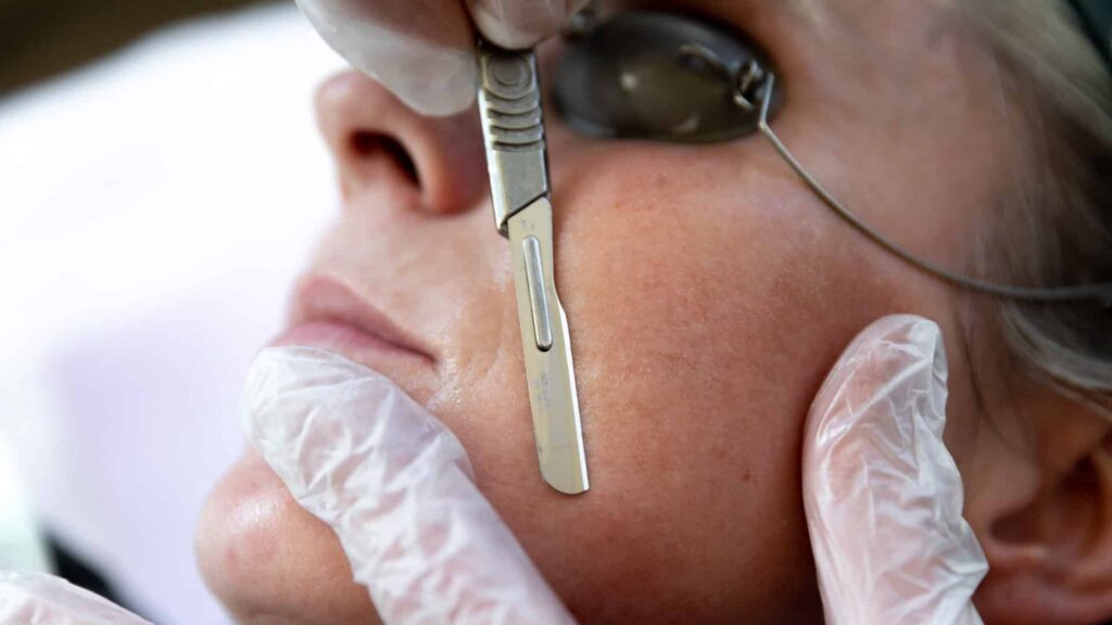 Premier Skin Clinic Dermaplaning 1 Premier Skin Clinic Dermaplaning 1