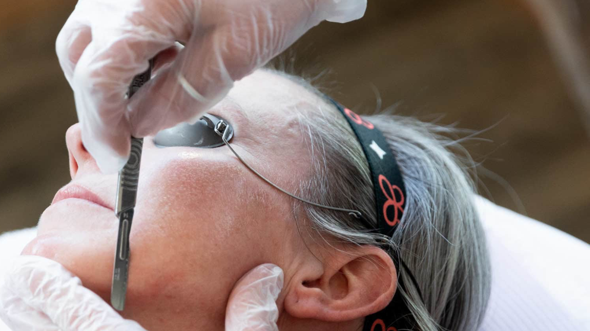 Premier Skin Clinic Dermaplaning 2 Premier Skin Clinic Dermaplaning 2