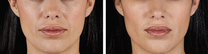 juvederm 2