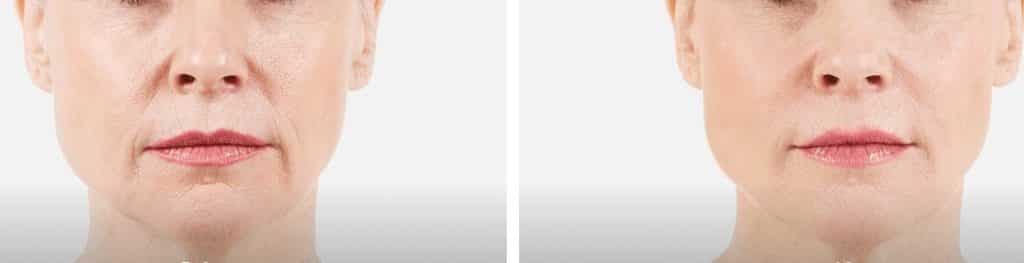 new beauty wellness juvederm before and after 3 2 1024x263