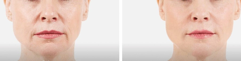 Before and After Image: DERMAL FILLERS - front