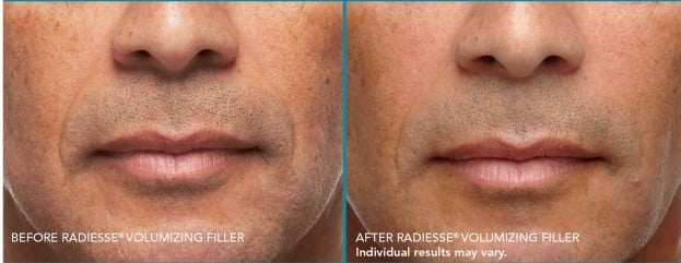 Before and After Image: DERMAL FILLERS - front