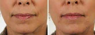 Before and After Image: DERMAL FILLERS - front