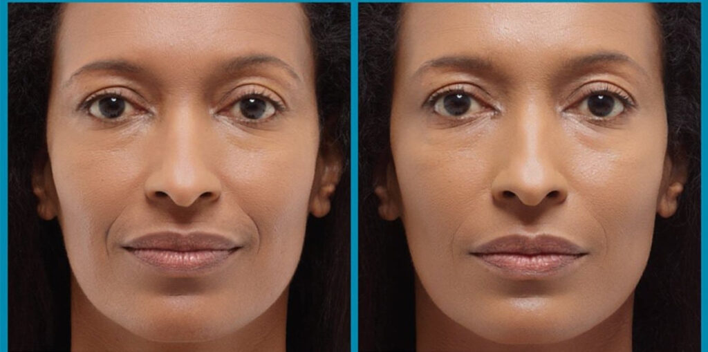 Before and After Image: DERMAL FILLERS - front