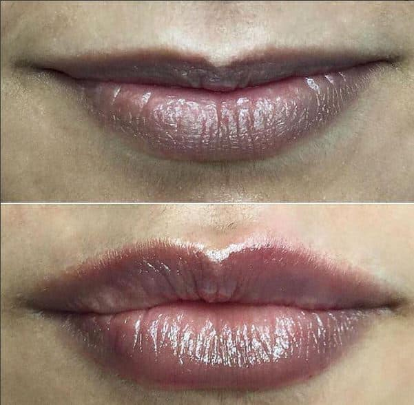 Before and After Image: DERMAL FILLERS - front