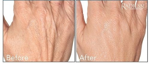 Before and After Image: Dermal Fillers - front