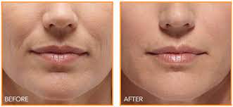 Before and After Image: DERMAL FILLERS - front