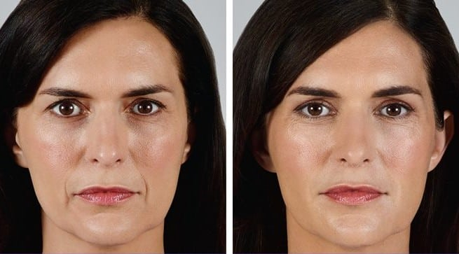 Before and After Image: Dermal Fillers - front