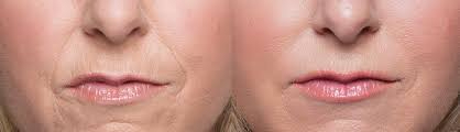 Before and After Image: DERMAL FILLERS - front