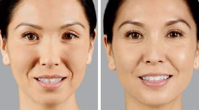 Before and After Image: Dermal Fillers - front