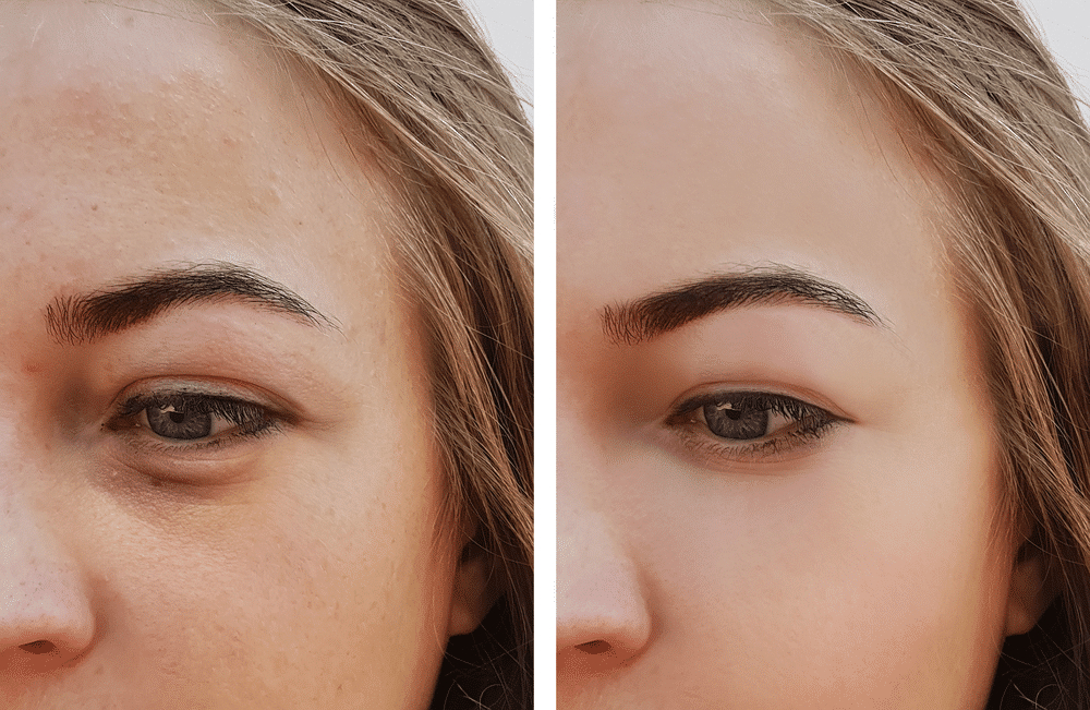 Before and After Image: DERMAL FILLERS - front