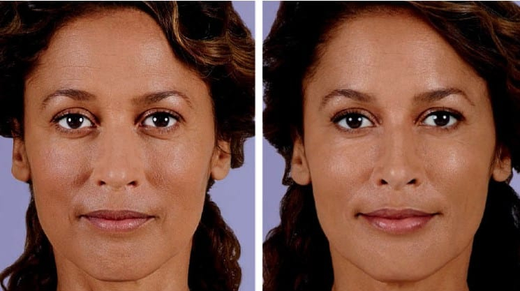 Before and After Image: Dermal Fillers - front