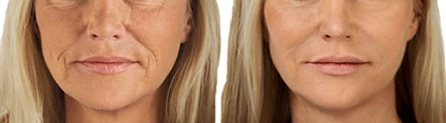 Before and After Image: DERMAL FILLERS - front