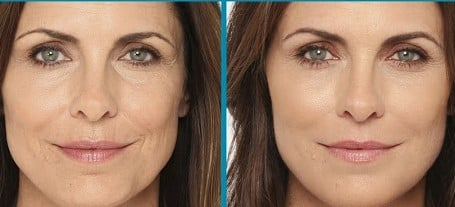 Before and After Image: DERMAL FILLERS - front