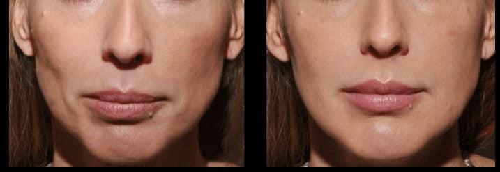 Before and After Image: DERMAL FILLERS - front
