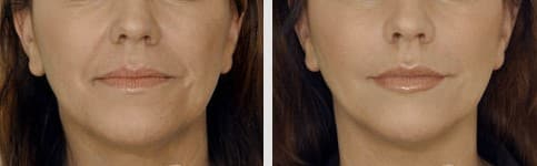 Before and After Image: DERMAL FILLERS - front