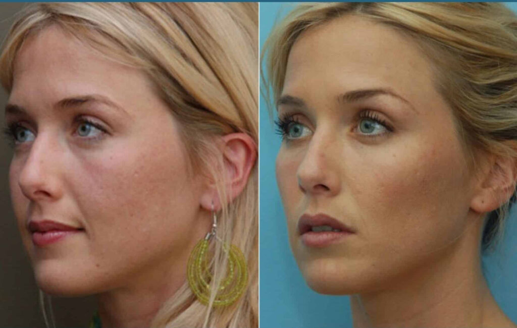 Before and After Image: DERMAL FILLERS - left-front-oblique
