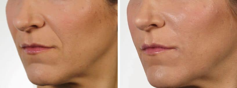 Before and After Image: DERMAL FILLERS - front