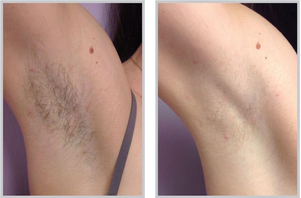 Before and After Image: ForeverBare BBL - front