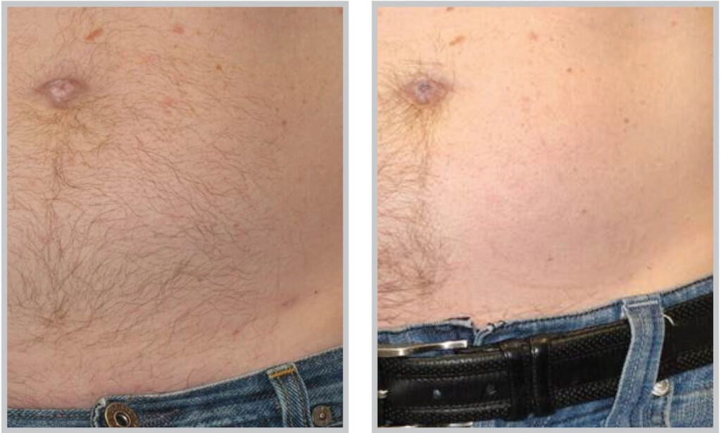 Before and After Image: ForeverBare BBL - front
