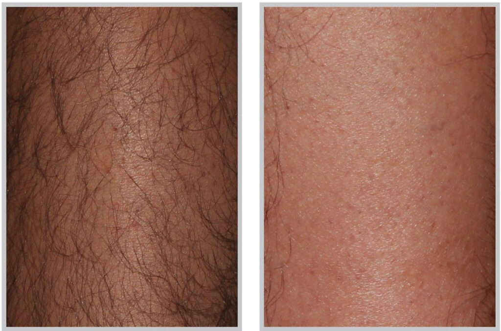 Before and After Image: ForeverBare BBL - front