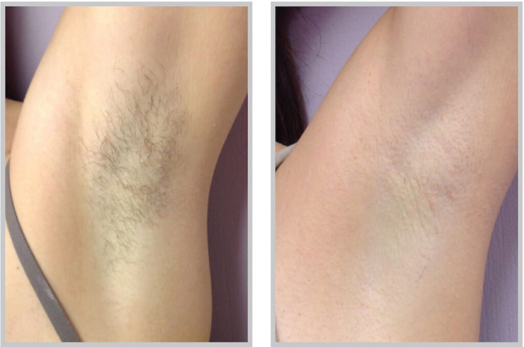 Before and After Image: ForeverBare BBL - front