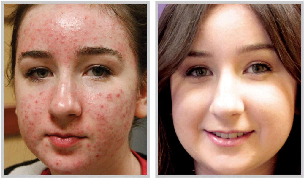 Before and After Image: ForeverClear BBL - front