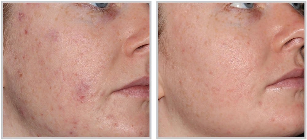 Before and After Image: ForeverClear BBL - right-front-oblique