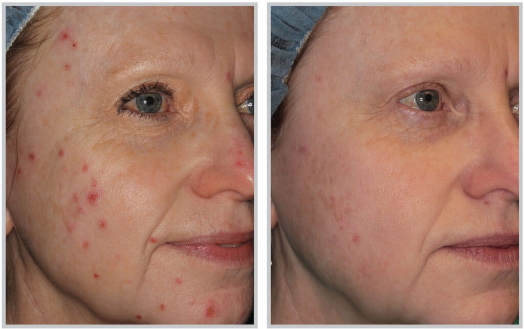 Before and After Image: ForeverClear BBL - right-front-oblique