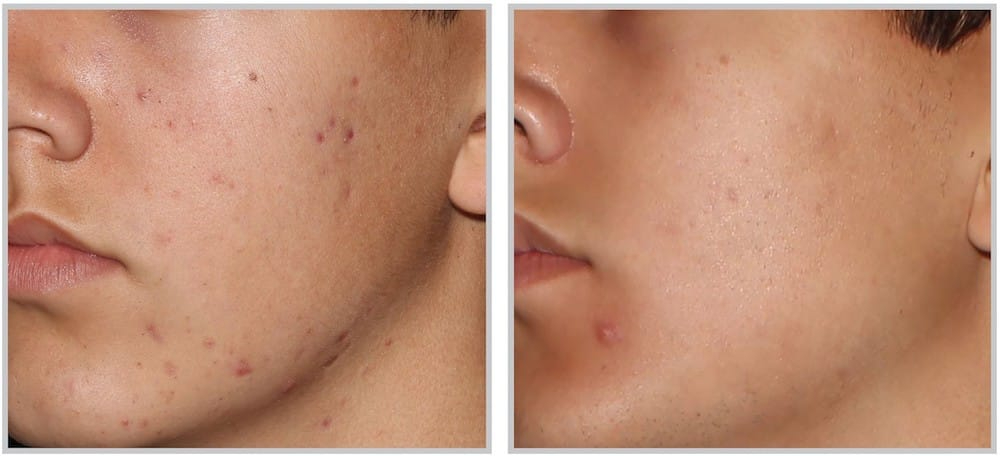 Before and After Image: ForeverClear BBL - left-front-oblique