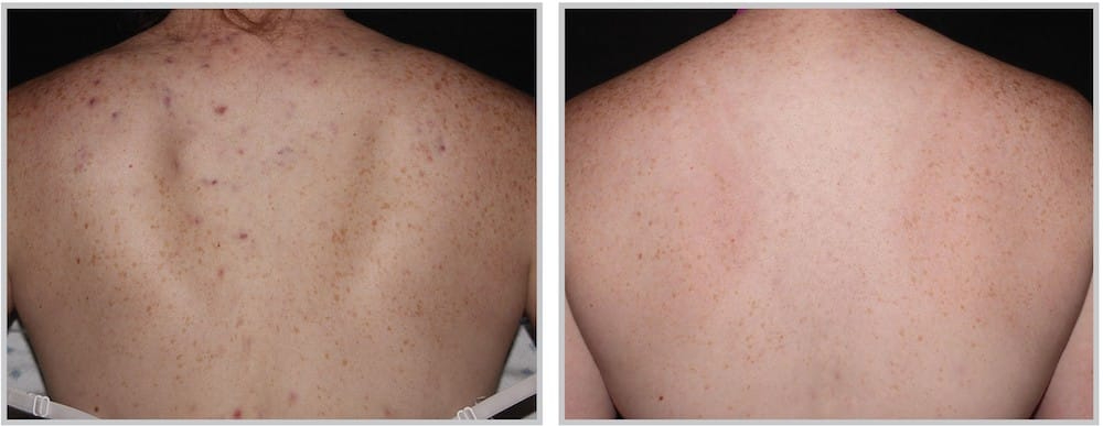 Before and After Image: ForeverClear BBL - back