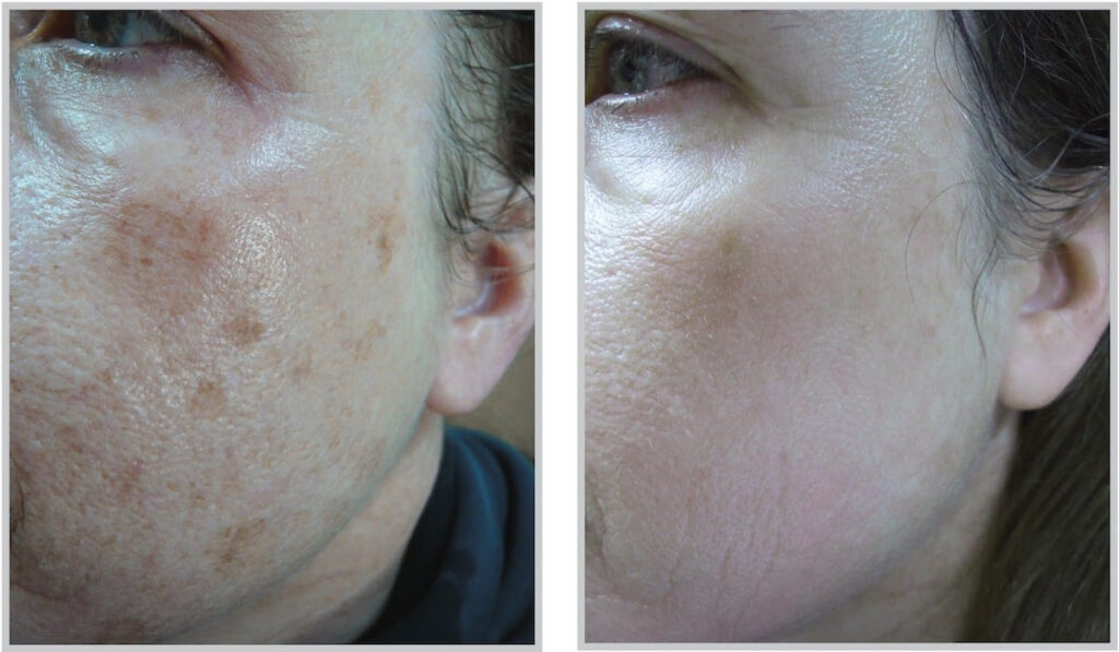 Before and After Image: ForeverYoung BBL - left-front-oblique