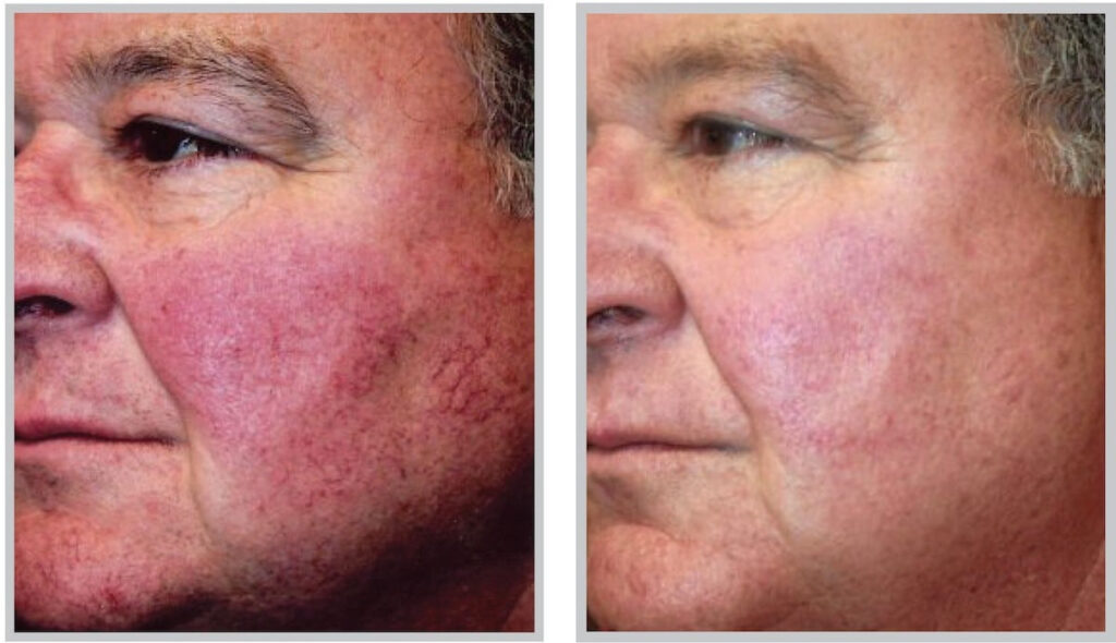 Before and After Image: ForeverYoung BBL - left-front-oblique
