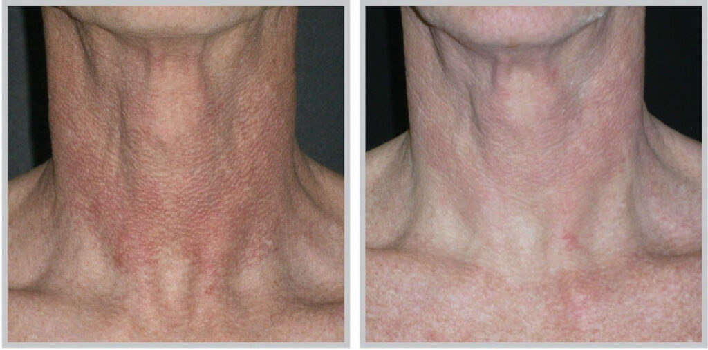 Before and After Image: ForeverYoung BBL - front