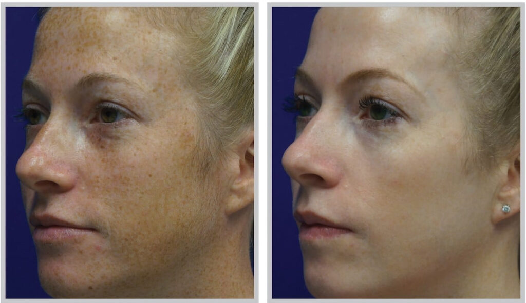 Before and After Image: ForeverYoung BBL - left-front-oblique