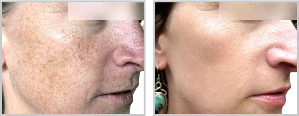 Before and After Image: ForeverYoung BBL - right-front-oblique