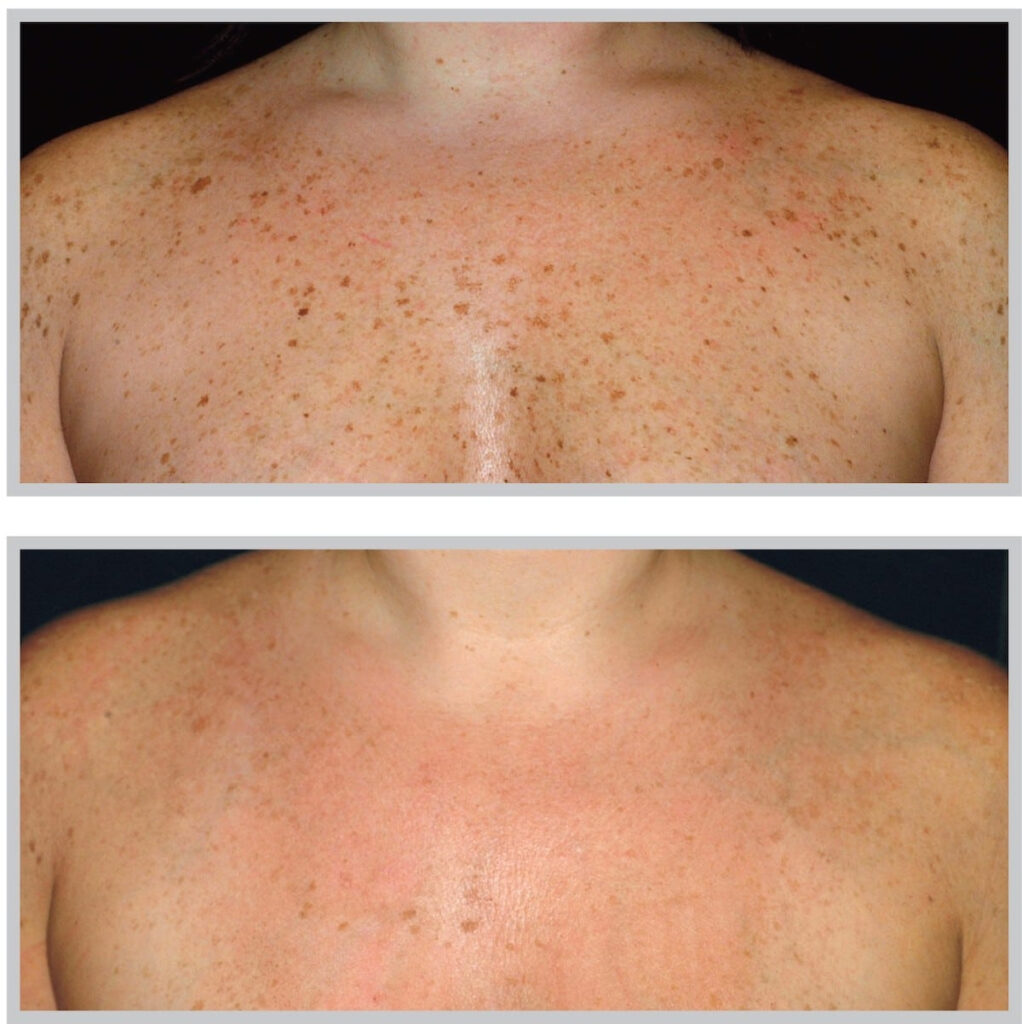 Before and After Image: ForeverYoung BBL - front