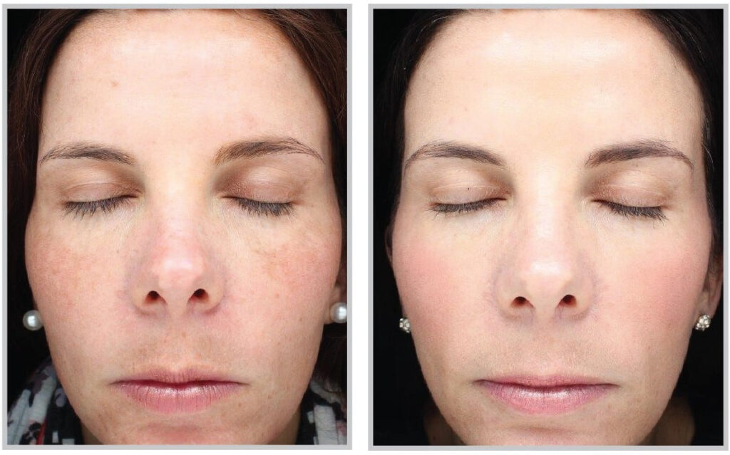 Before and After Image: Halo - front